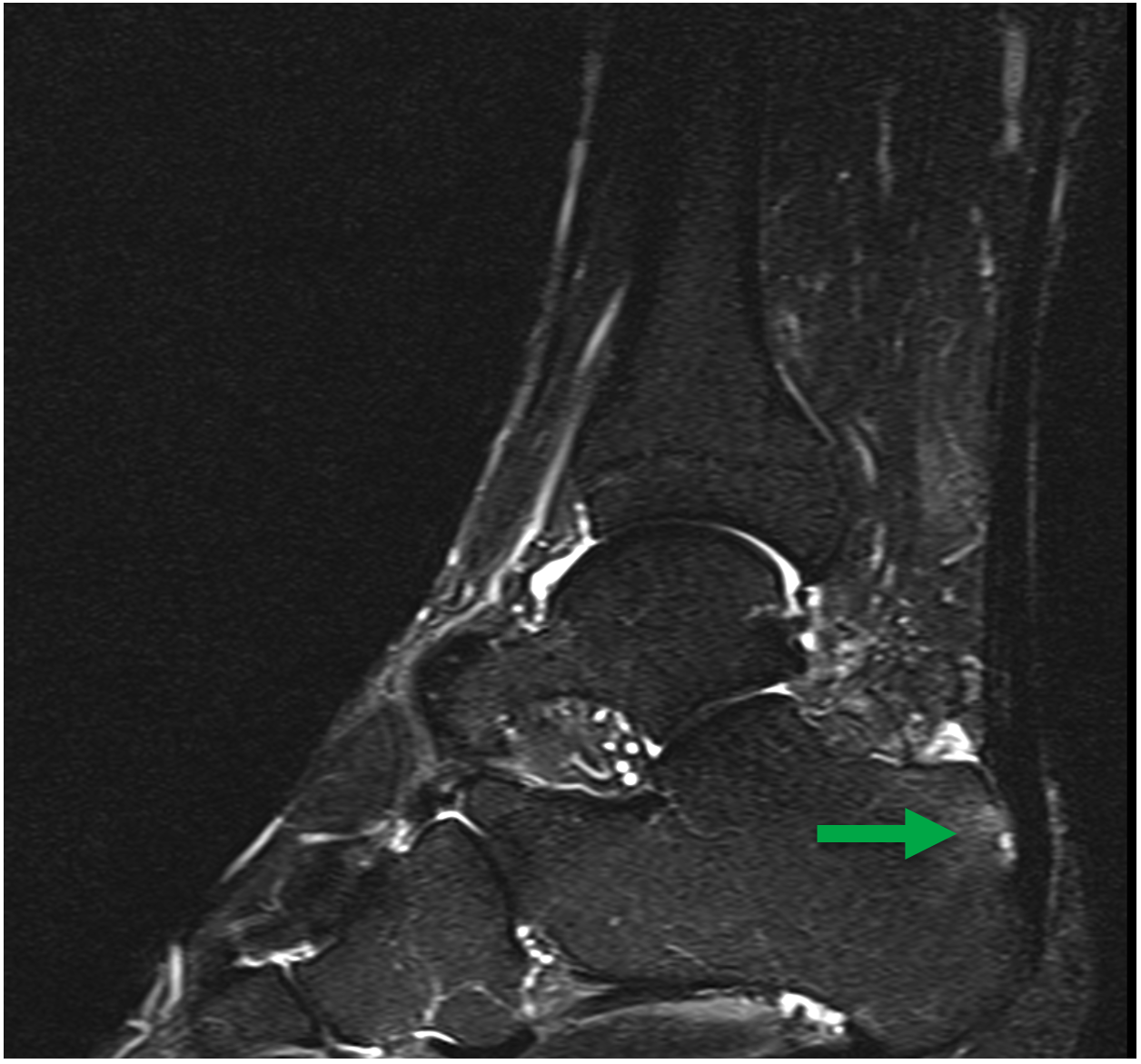 MRI eines 45-jährigen Marathonläufers mit Achillessehnen-Ansatz-Entzündung mit Ödem im Bereich der Haglund-Exostose (weisser Bereich des Fersen-Knochens).