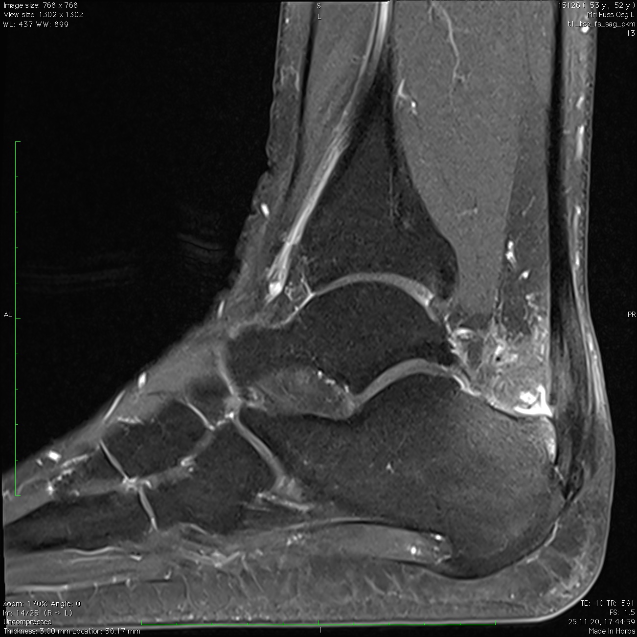 MRI mit Haglund-Exostose, Achillessehnen-Ansatz Tendinitis mit Partialrupturen, Bursitis subachillea und kleinem Fersensporn.
